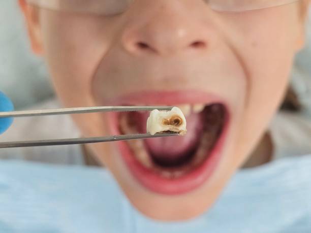 Best Emergency Dental Extractions in Fostoria, OH